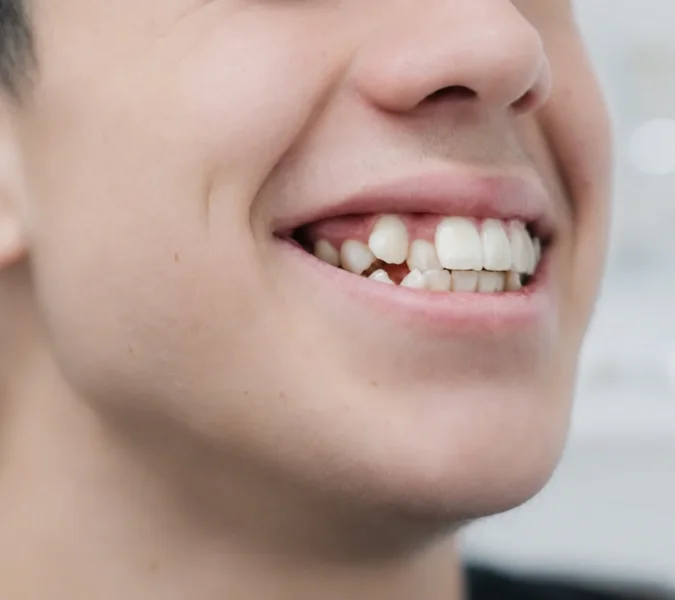 Before clear aligner treatment