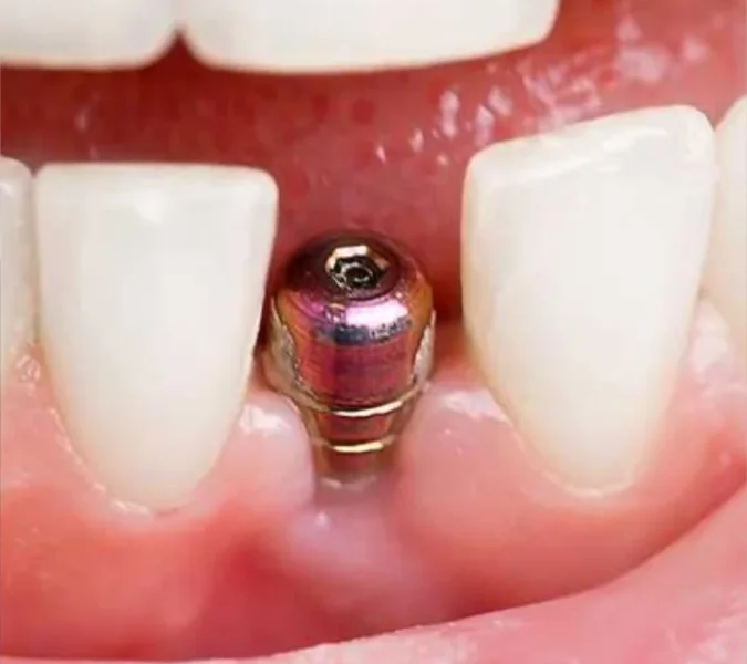 dental implant treatment